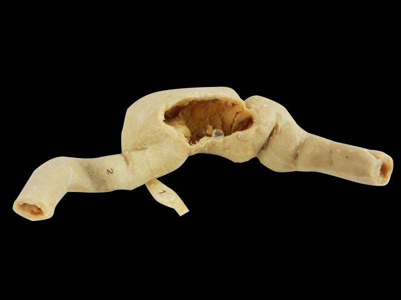 Cecum and appendix plastinated specimen