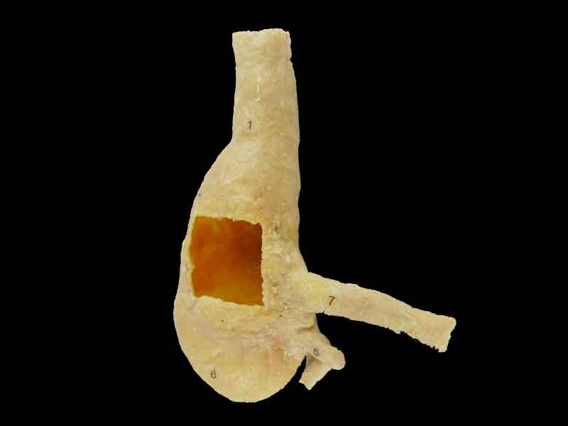 Cecum ileum and appendix