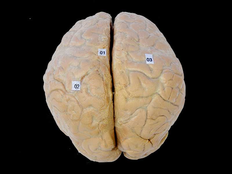 cerebral arachnoid mater plastination