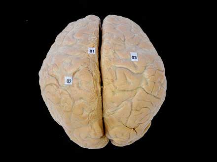 cerebral arachnoid mater plastination