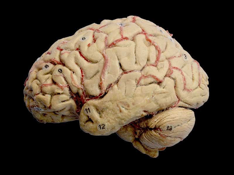 Cerebral hemisphere and brain stem plastination