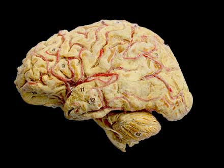 Cerebral hemisphere and brain stem plastination