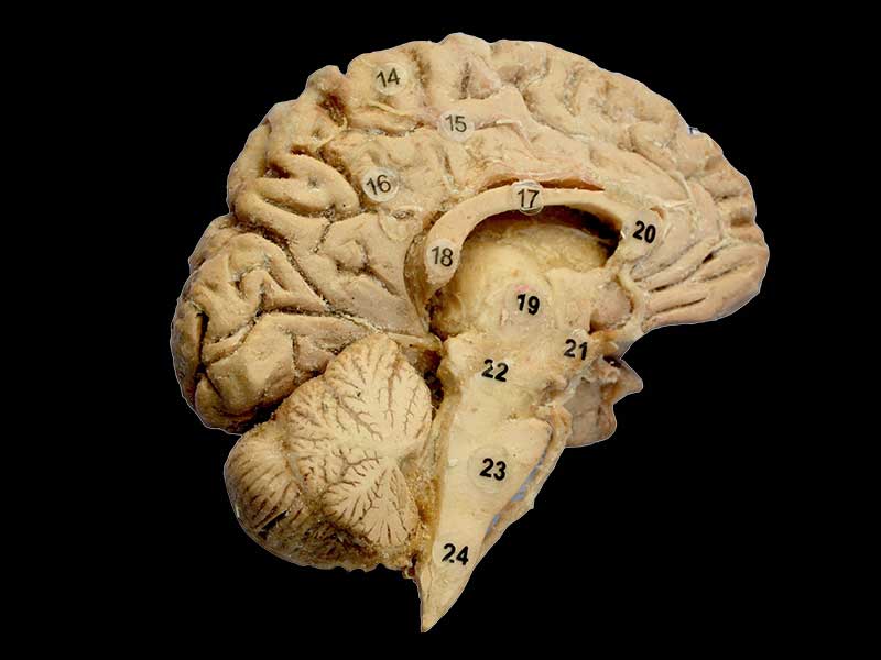 Cerebral hemisphere and brain stem specimen plastination
