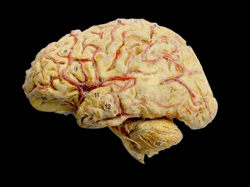 Cerebral hemisphere and brain stem
