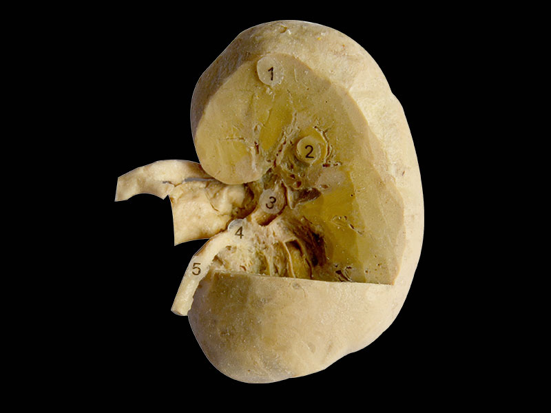 Coronal section of kidney 3 quaters plastinated specimen,male pelvis