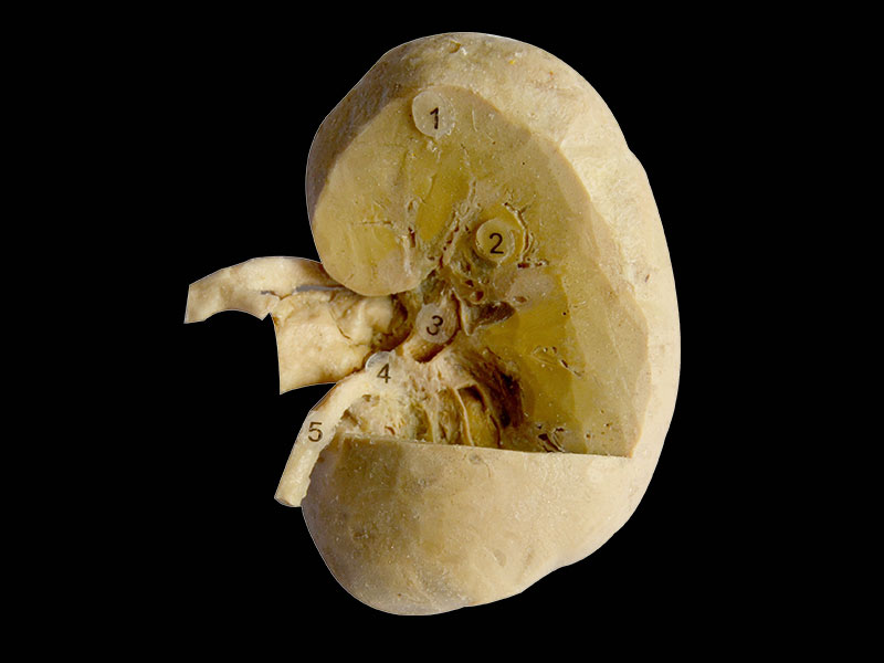 coronal section of kidney 3 quaters human plastination