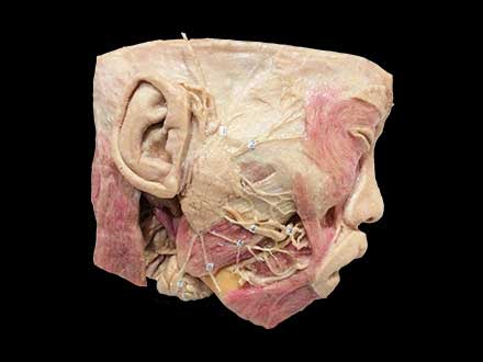 facial nerves and branches plastination