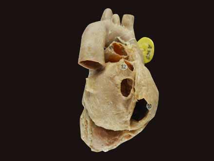 Heart showing coronary vessels