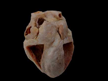 Heart specimen with ventricles opened to expose the valves