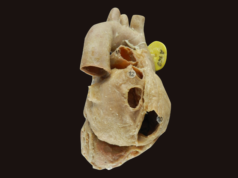 Heart with coronary vessels plastination