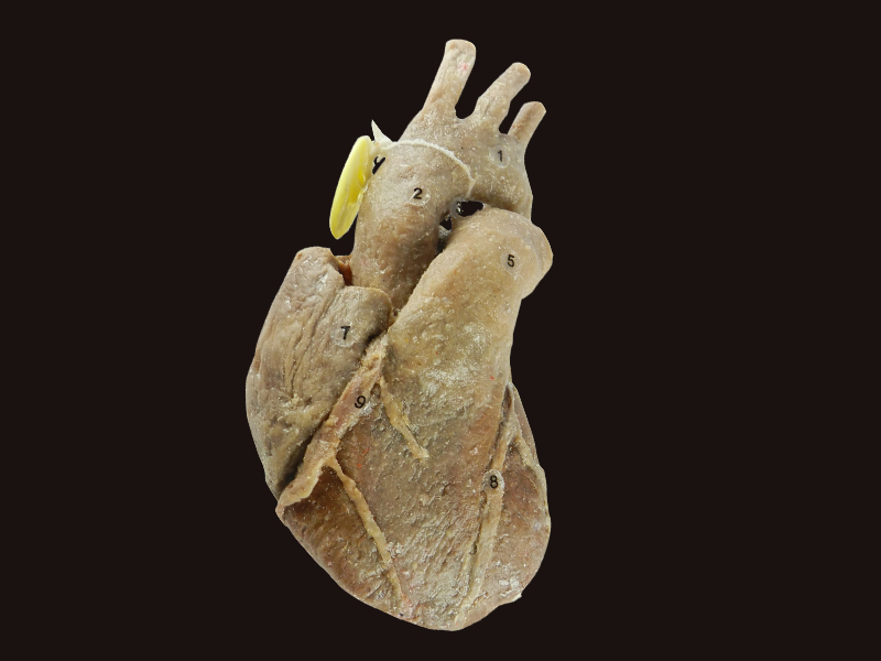 Heart with coronary vessels