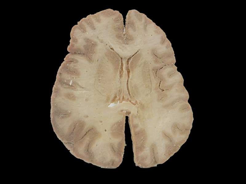 Horizontal section of brain through inner capsule plastinated specimen