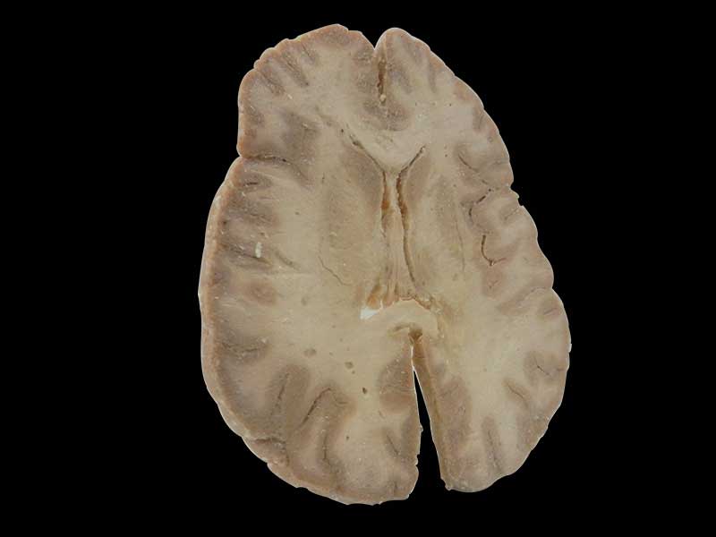 Horizontal section of brain through inner capsule plastination