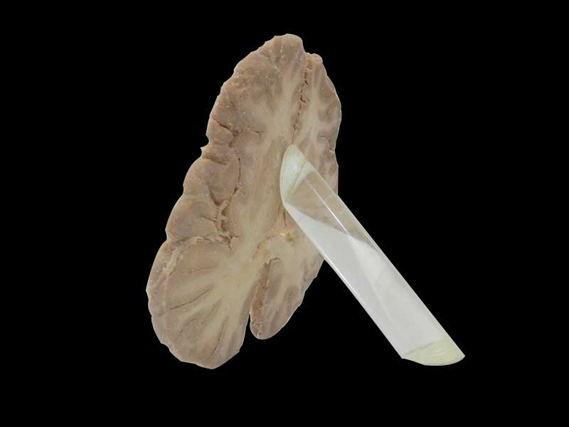 Horizontal section of brain through inner capsule