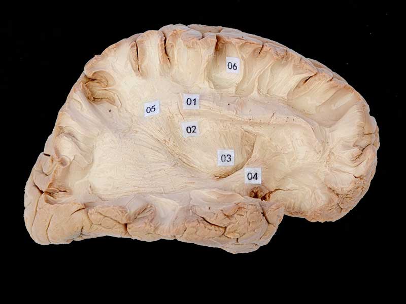 Human association fiber of cerebral hemisphere