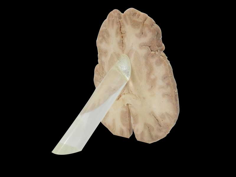 Human horizontal section of brain through inner capsule plastination