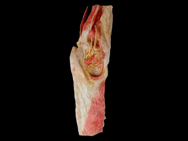 Human lumbosacral Plexus in situ