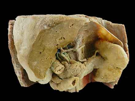 Liver, spleen, pancreas,  and duodenum