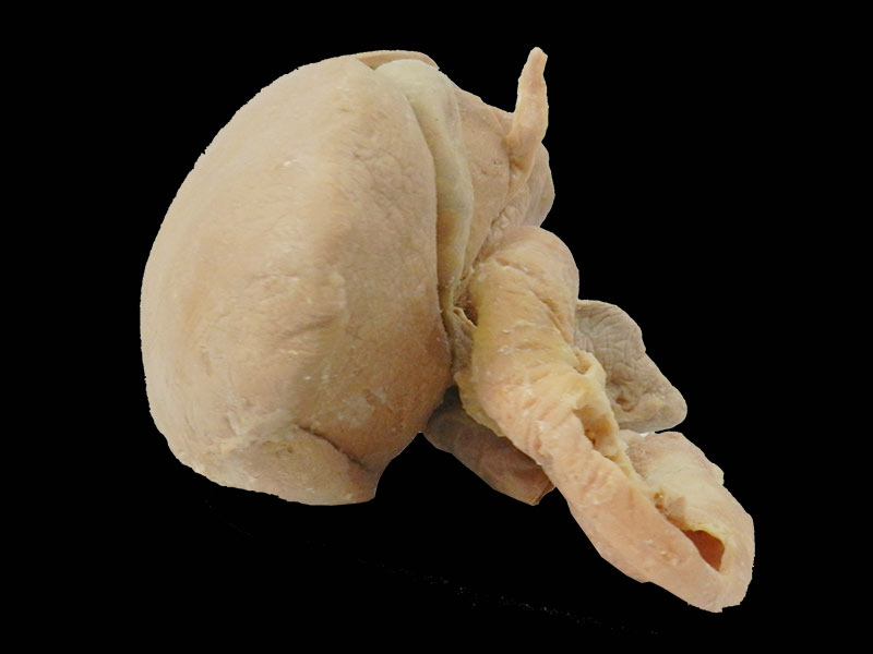 Liver pancreas duodenum spleen medical specimen