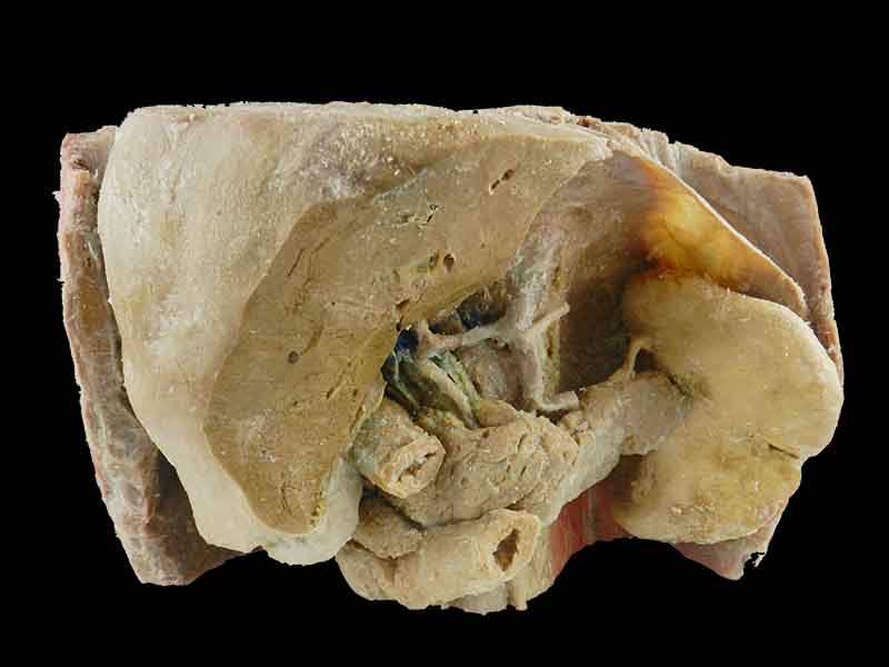 Liver spleen pancreas  and duodenum plastinated specimen