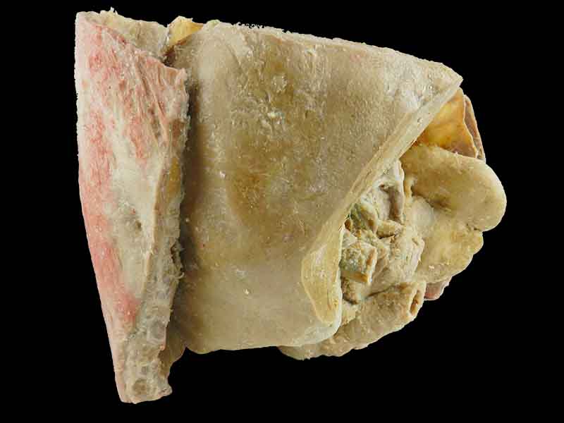 Liver spleen pancreas  and duodenum plastination