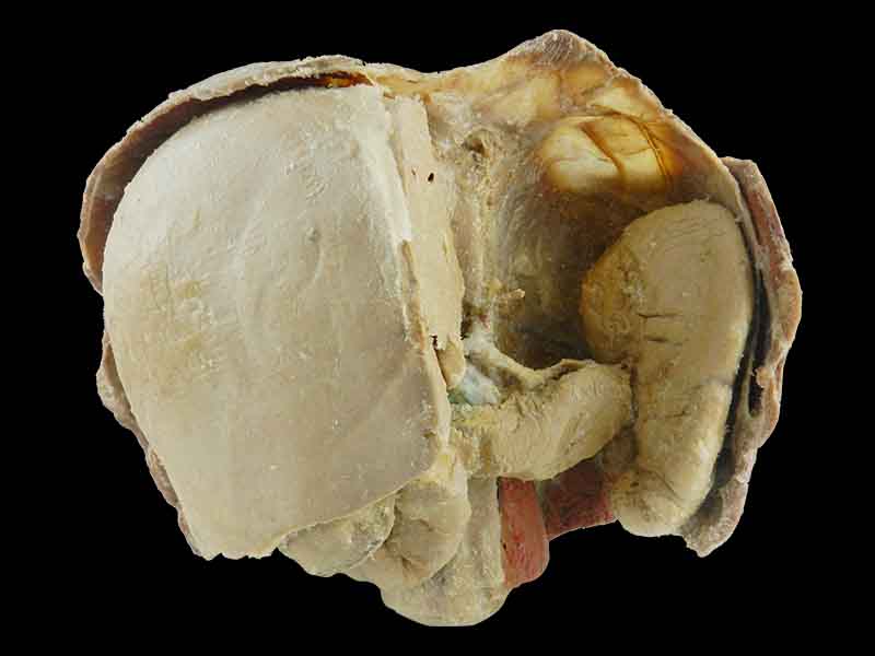 Liver spleen pancreas  and duodenum teaching specimen