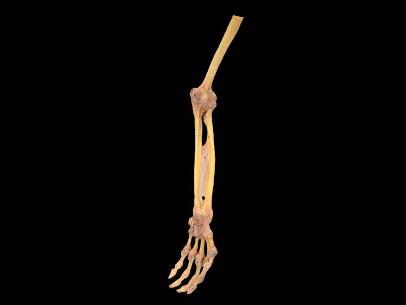 forearm bone union