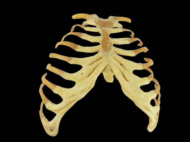 Sternum stemocostal and costochondoral junction for sale
