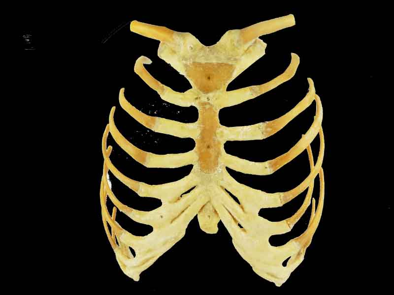 Sternum stemocostal and costochondoral junction specimen