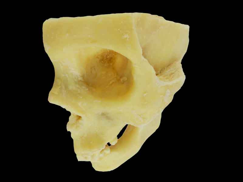 temporomandibular articulation plastination