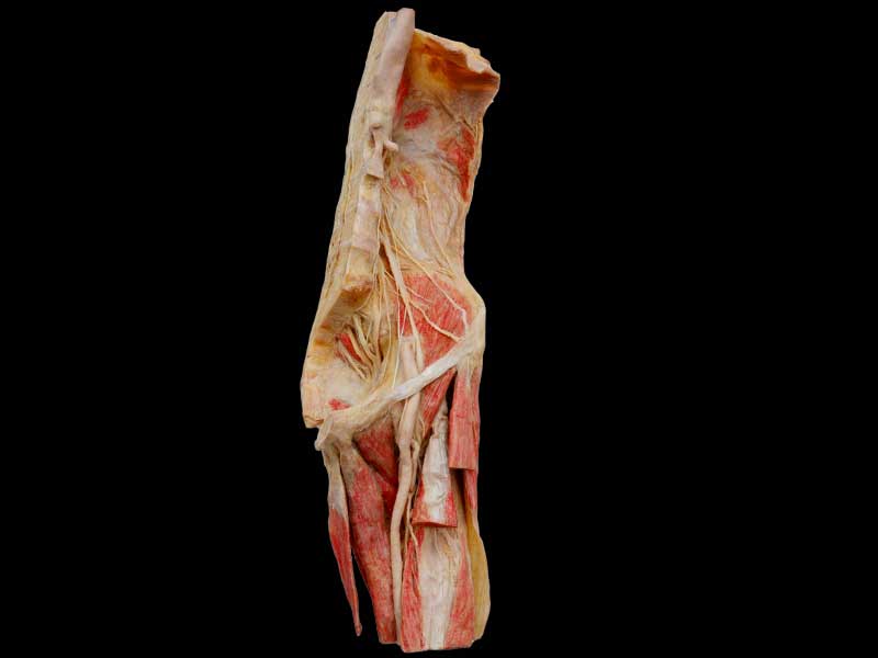 Lumbosacral Plexus in Situ