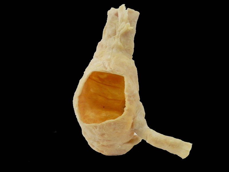 medical ileocecal junction specimen