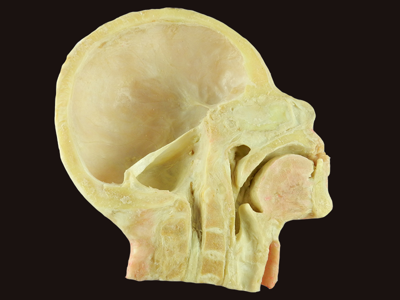 Muscles of neck and carotid medical specimen