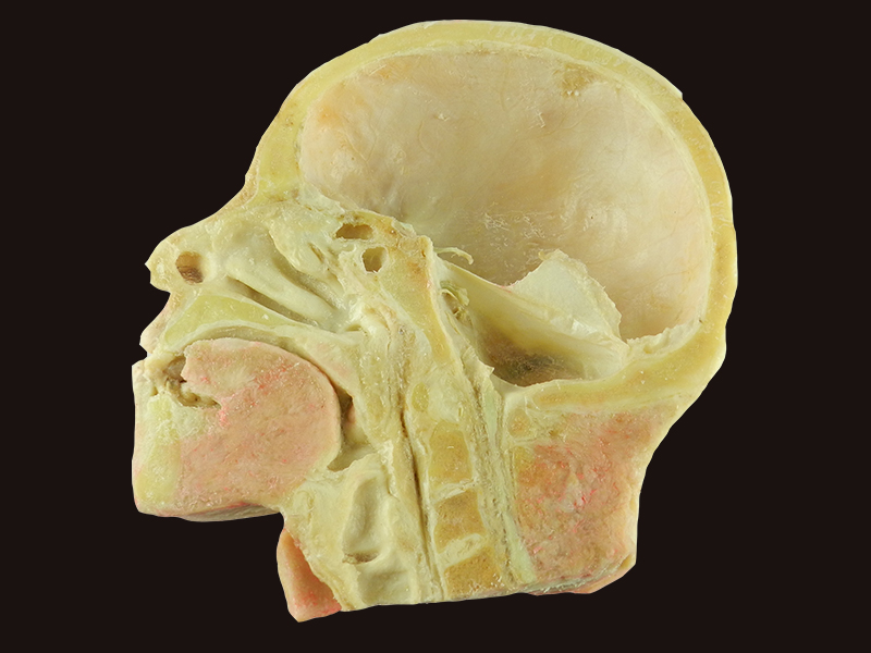 Muscles of neck and carotid plastination