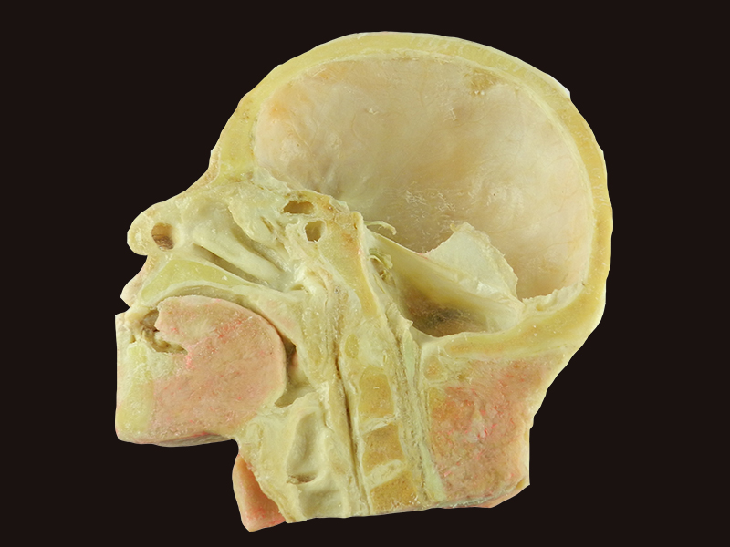 Muscles of neck and carotid teaching specimen