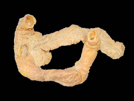 pancreas duodenum specimen