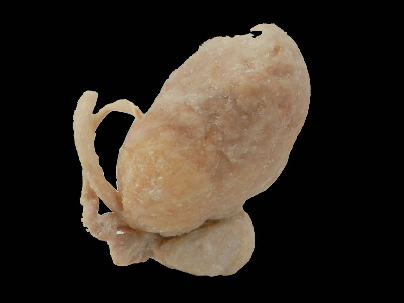 Prostate seminal vescle bladder human specimen