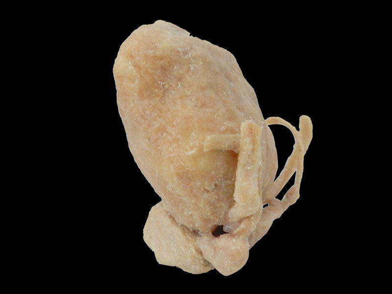 Prostate seminal vescle bladder plastination