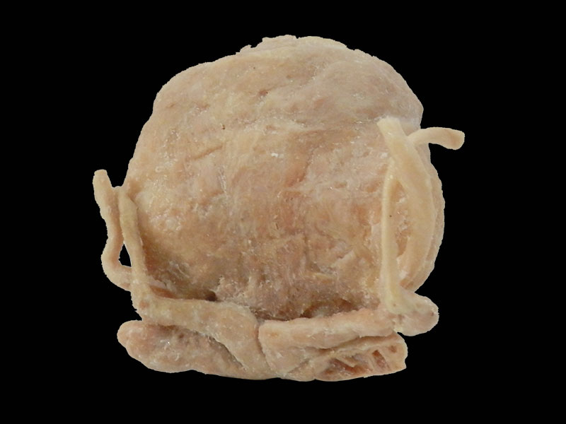 Prostate seminal vescle bladder