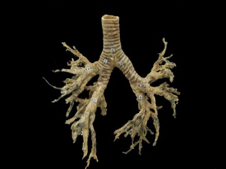 Bronchial tree plastinated specimens( plastination von hagens  )