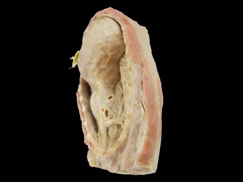 Mediastinum plastination