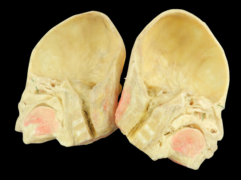 Paranasal sinuses and its opening