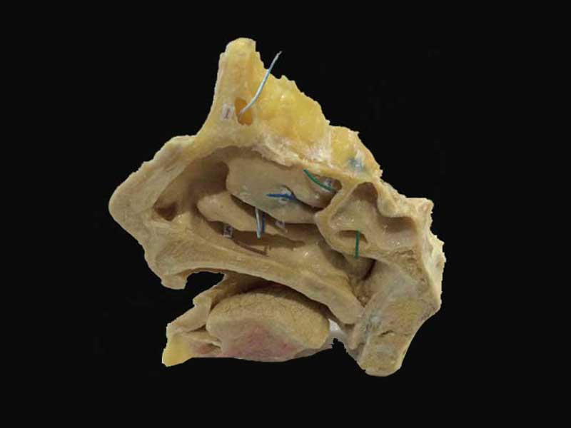 Paranasal sinuses and its opening plastinated specimens(plastination exhibit  )