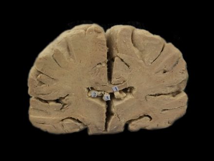 Coronal section of brain plastinated specimens