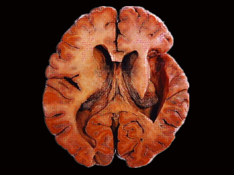 Lateral ventricles plastinated specimens