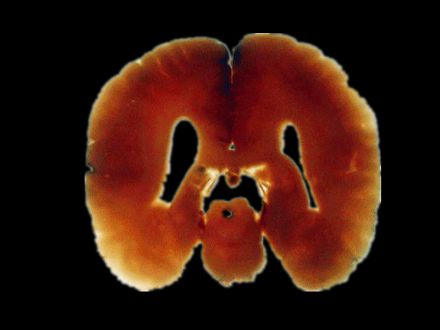 Median sagittal section of brain embedded slice