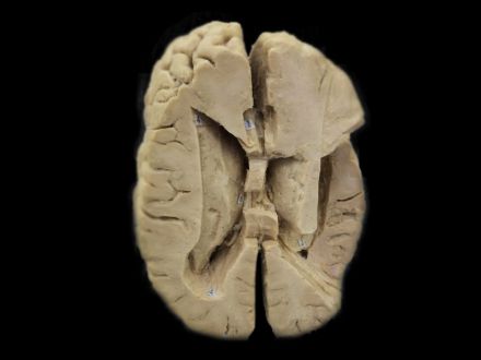Ventricles and brain Island plastinated specimens