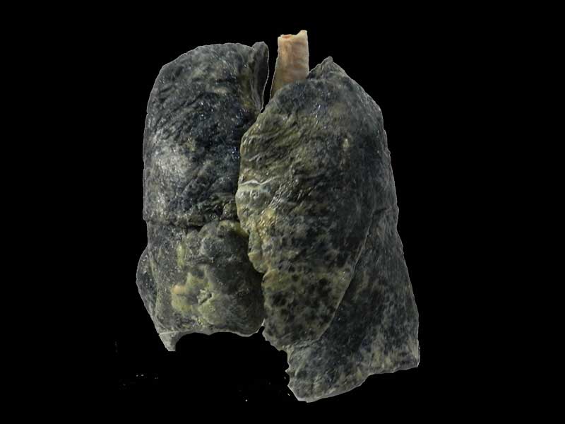 smoker lung plastination specimen