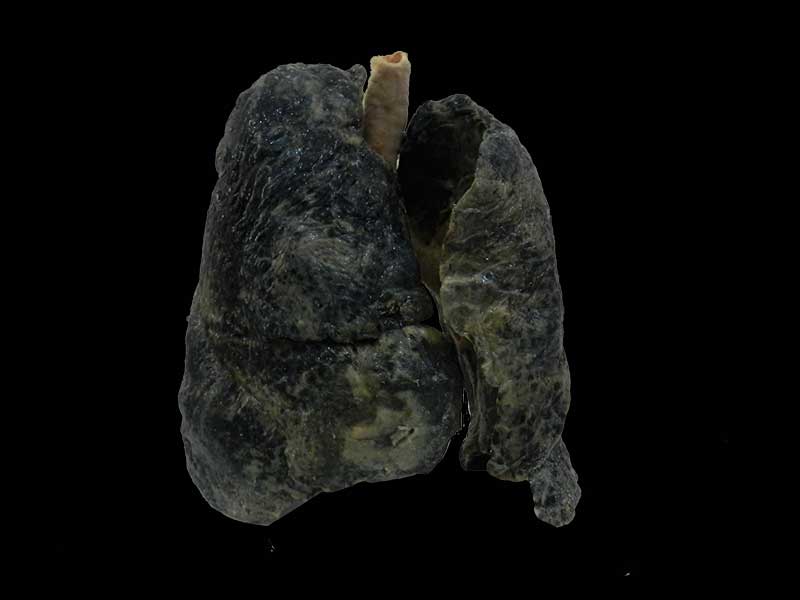 smoker lung