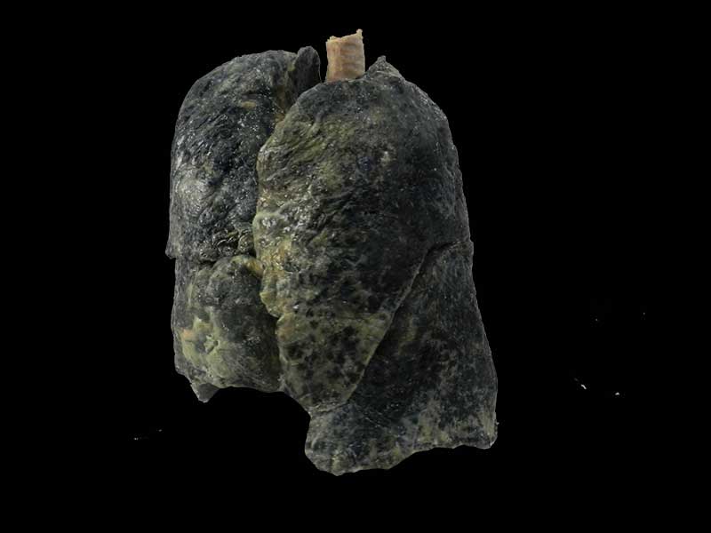 The lung of smoker plastinated specimen